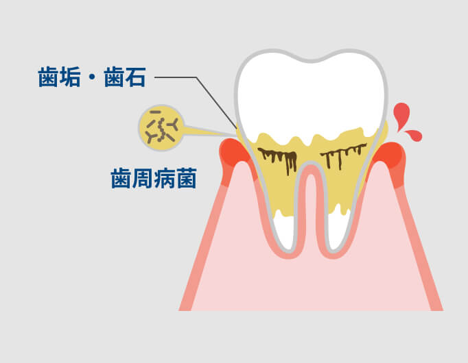 歯垢、歯周病菌が歯についている様子