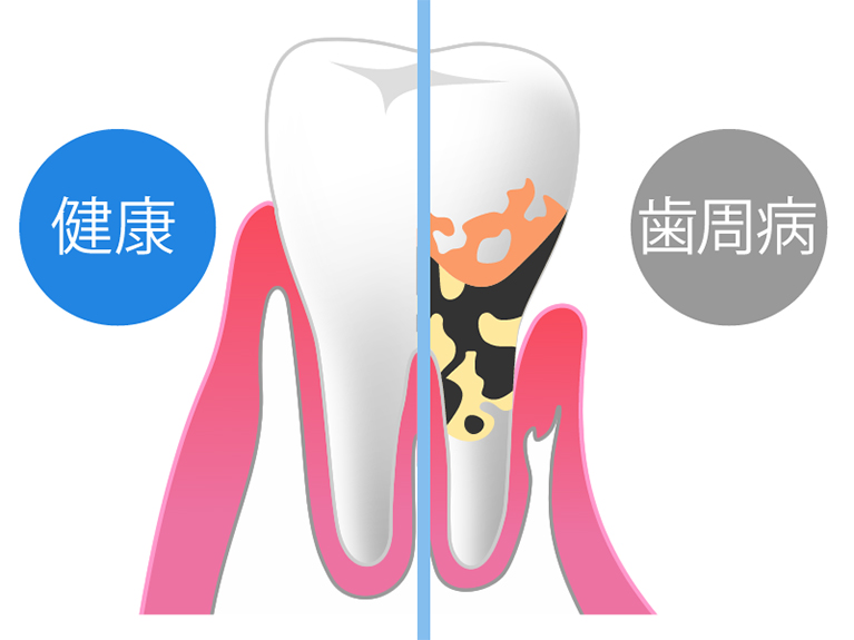 歯周病は予防が大切